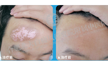 白癜風為什么不容易治愈