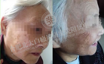 趙阿姨半年眼部白斑治好了
