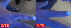 白斑治好了，7歲男孩不再被叫“花花牛”