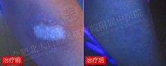 暴曬誘發(fā)白癜風，北大還女孩一個健康童年