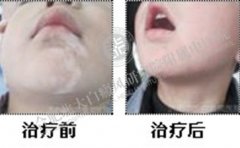 7歲兒童挑食遇見“白癜風(fēng)”