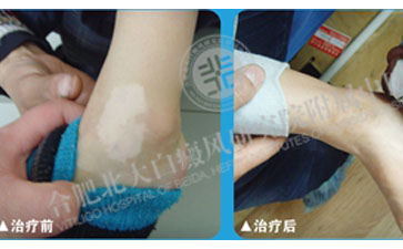 年輕是白癜風不能困擾的