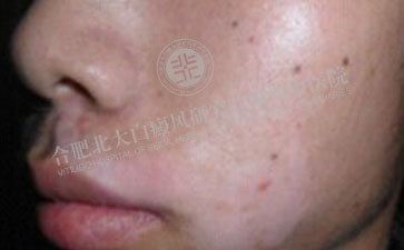 白癜風康復 男孩快樂成長