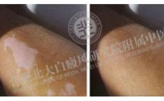 他把學生視作一切 可是自己卻被白斑困擾著