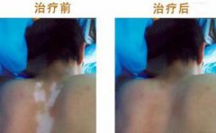 白斑的不斷擴散給他帶來沉重的打擊