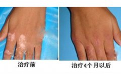 手背上的白癜風什么時候能痊愈