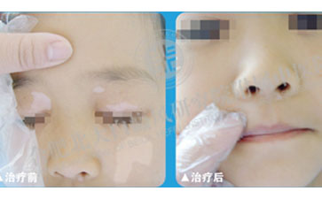 袪“白”成功，還孩子一個快樂的童年
