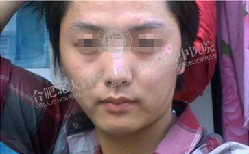 告別白癜風，輕松面對高考