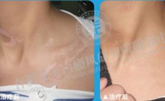 合肥白癜風患者復色案例