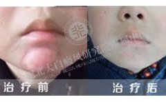 白斑再見，童年你好